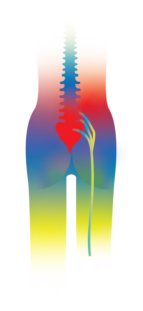 Sciatica Diagram